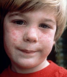 Çocukluk çağında sık görülen bulaşıcı döküntülü hastalıklar: KIZAMIK