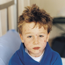 Çocukluk çağında sık görülen bulaşıcı döküntülü hastalıklar: SU ÇİÇEĞİ